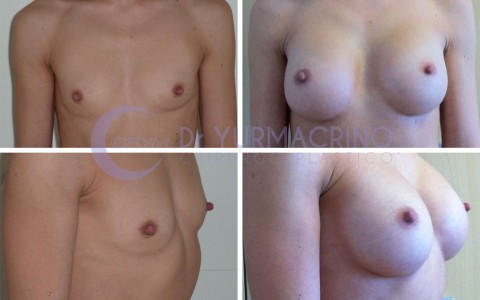 Breast Augmentation – Case 7