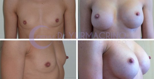 Breast Augmentation – Case 7