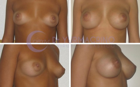 Breast Augmentation – Case 8