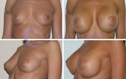 Breast Augmentation – Case 9