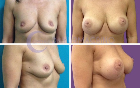 Breast Augmentation – Case 10