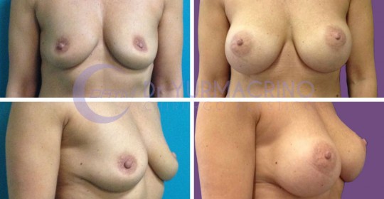 Breast Augmentation – Case 10