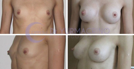 Breast Augmentation – Case 11