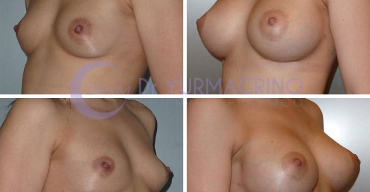 Breast Augmentation – Case 12