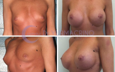 Breast Augmentation – Case 13