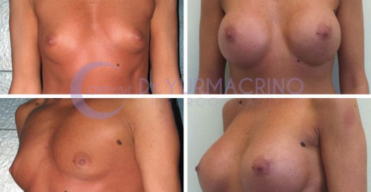 Breast Augmentation – Case 13