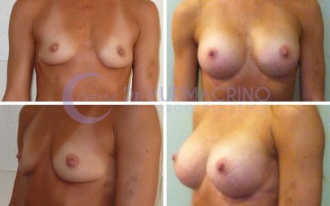 Breast Augmentation – Case 15