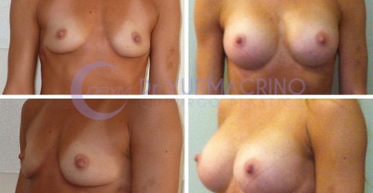 Breast Augmentation – Case 15