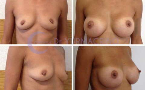 Breast Augmentation – Case 16