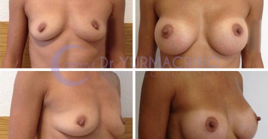 Breast Augmentation – Case 16