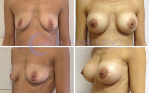 Breast Augmentation – Case 17