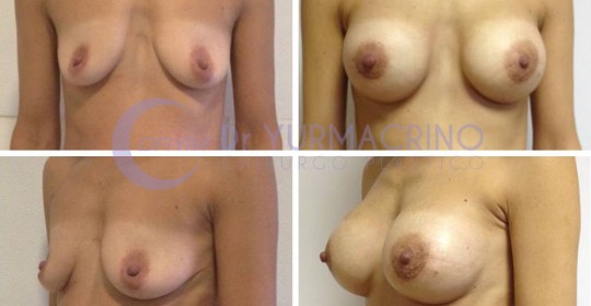 Breast Augmentation – Case 17