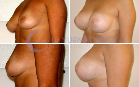 Breast Augmentation – Case 18