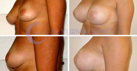 Breast Augmentation – Case 18