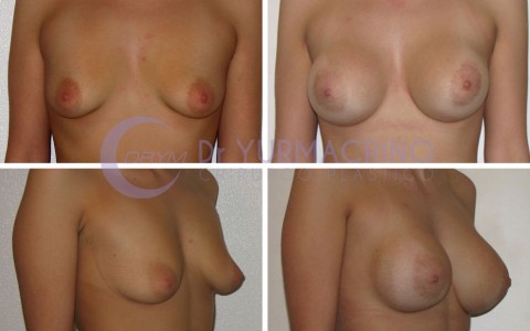 Breast Augmentation – Case 19