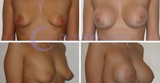 Breast Augmentation – Case 19