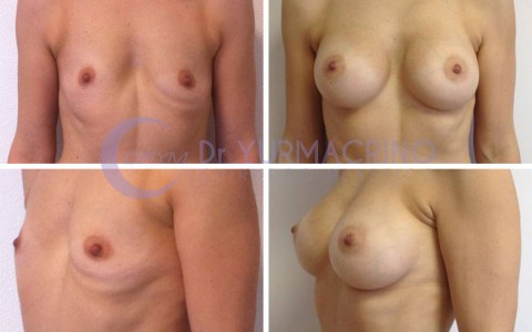 Breast Augmentation – Case 20