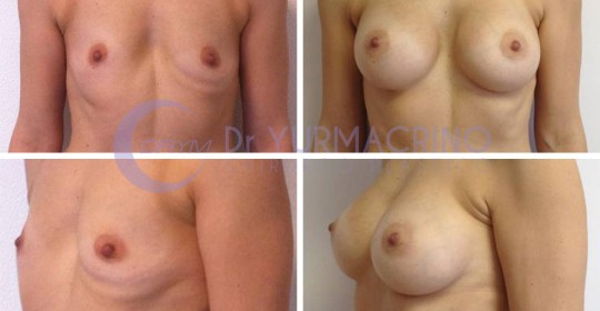 Breast Augmentation – Case 20