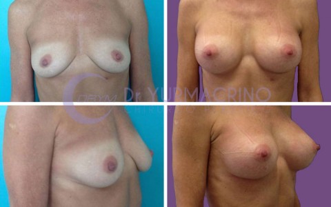 Breast Augmentation – Case 21