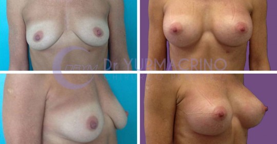 Breast Augmentation – Case 21