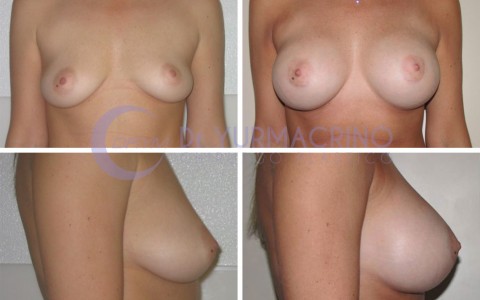 Breast Augmentation – Case 22