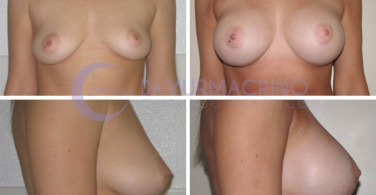 Breast Augmentation – Case 22