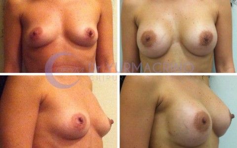 Breast Augmentation – Case 23