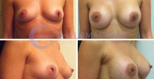 Breast Augmentation – Case 23