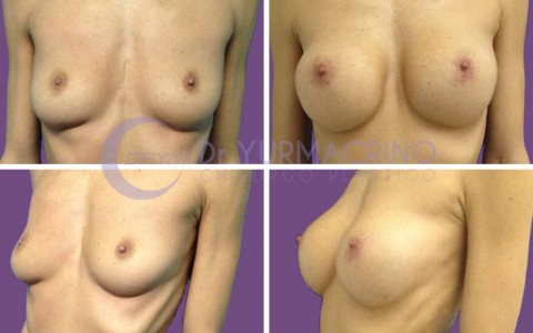 Breast Augmentation – Case 24