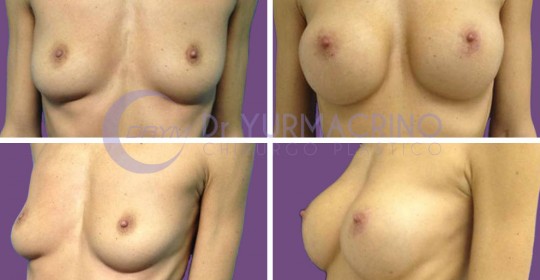 Breast Augmentation – Case 24