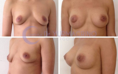 Breast Augmentation – Case 25