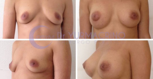 Breast Augmentation – Case 25