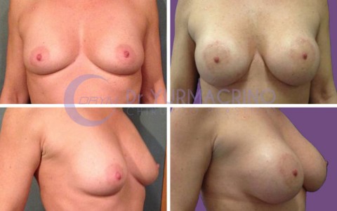 Breast Augmentation – Case 26