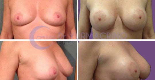 Breast Augmentation – Case 26