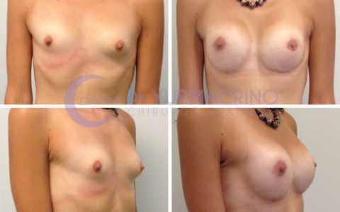 Breast Shape Correction – Case 1