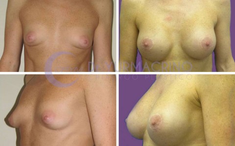 Breast Shape Correction – Case 3