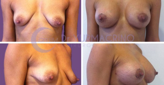 Breast Shape Correction – Case 5