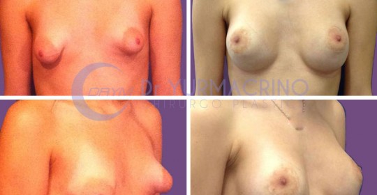 Breast Shape Correction – Case 6