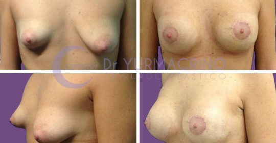 Breast Shape Correction – Case 8