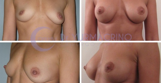 Breast Shape Correction – Case 9