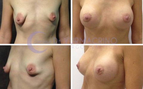 Breast Shape Correction – Case 11