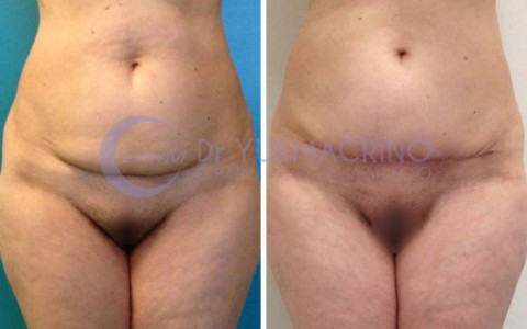 Mini-abdominoplasty – Case 1/A