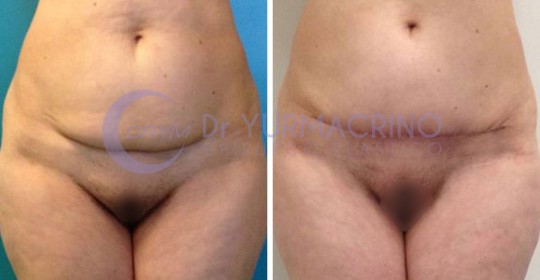 Mini-abdominoplasty – Case 1/A