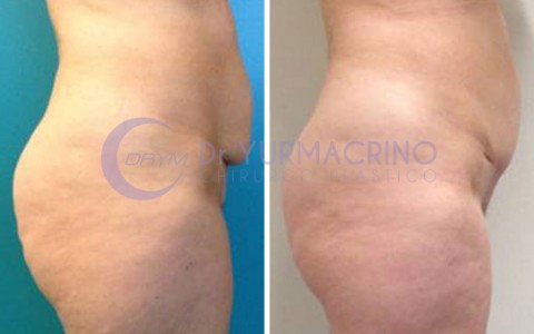 Mini-abdominoplasty – Case 1/B