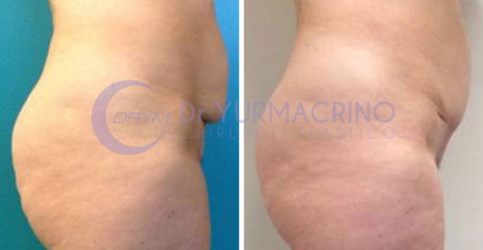 Mini-abdominoplasty – Case 1/B