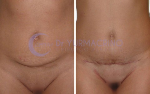 Mini-abdominoplasty – Case 2/A