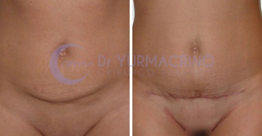 Mini-abdominoplasty – Case 2/A