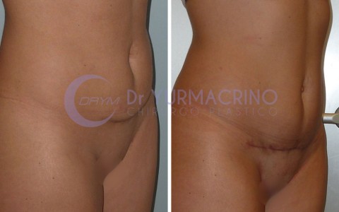 Mini-abdominoplasty – Case 2/B