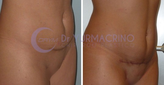 Mini-abdominoplasty – Case 2/B