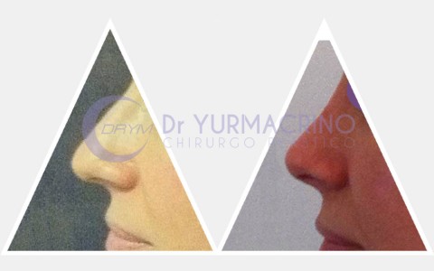 Rhinoplasty – Case 1/A